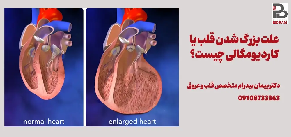 علت بزرگ شدن قلب