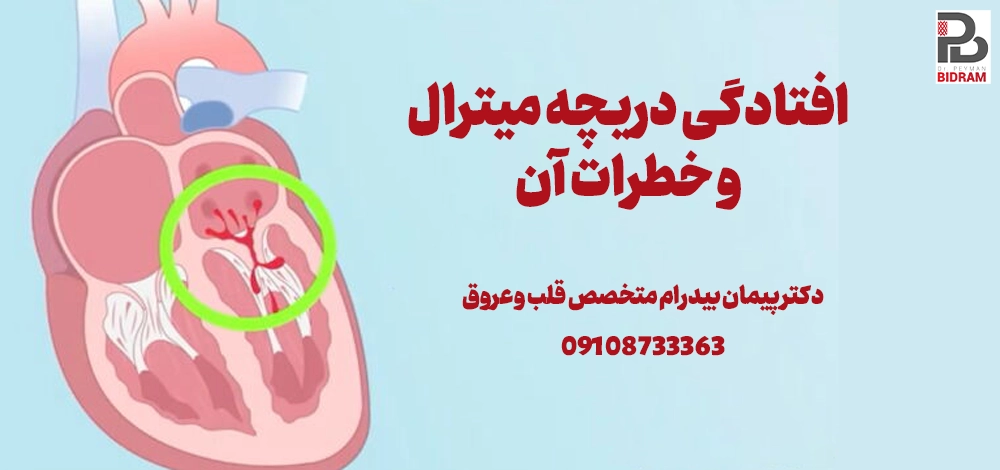 افتادگی دریچه میترال