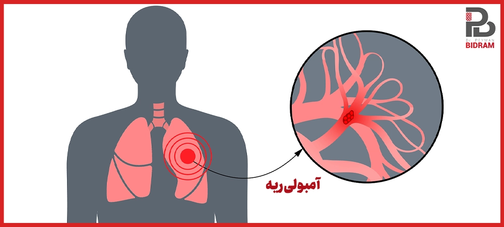 آمبولی ریه چیست