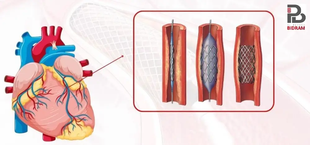 آنژیوگرافی قلب