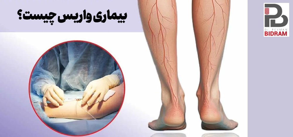 بیماری واریس چیست؟