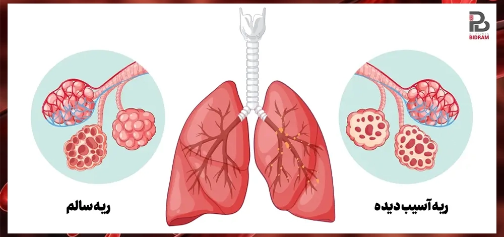 راه‌های پیشگیری از آمبولی ریه