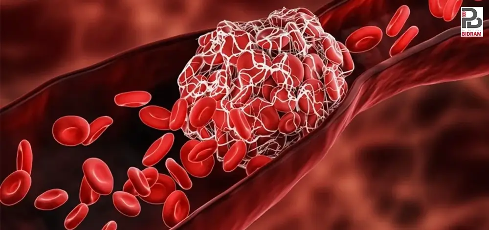 درمان آمبولی ریه