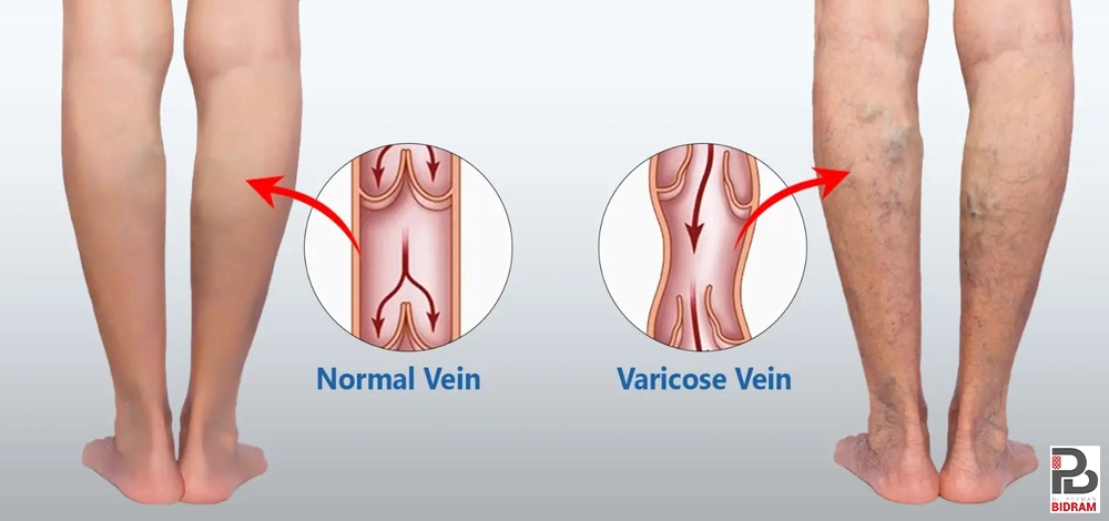 درد، سنگینی و تورم پا از علائم بیماری واریس