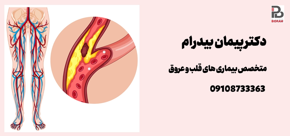 اسکلروتراپی، لیزر درمانی و جوراب واریس برای درمان واریس