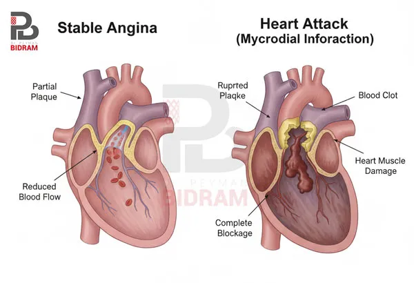 تفاوت سکته قلبی با آنژین صدری (Stable Angina)